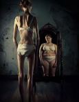anorexia