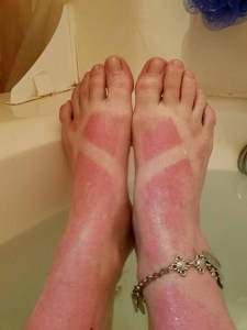 Sunburnt
